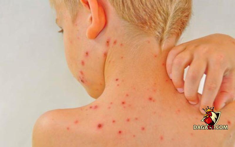 Cách trị mạt gà